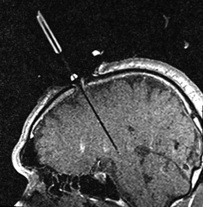 Intraoperative parasagittal T1-weighted MR image showing a DBS lead being positioned in the STN in a patient with PD