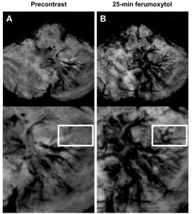 Figure 1. Developmental venous anomaly. A-B, Axial susceptibility-weighted images obtained before (A) and 25 minutes after ferumoxytol administration (B). Albeit the left cerebellar lesion is visible on both the pre- and post-ferumoxytol susceptibility-weighted images, the ferumoxytol scan demonstrates additional tributary veins (rectangle) compared to the precontrast sequence. Published in Dósa et al, Stroke 2011.4