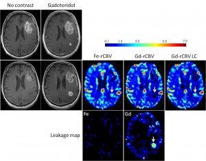 Figure 2. Axial images in 68-year-old man with GBM show discordance between rCBV values measured with ferumoxytol (Fe) and gadoteridol (Gd). T1-weighted MR images without contrast agent and with gadoteridol obtained before and 2 weeks after chemoradiotherapy (CRT) show increased contrast enhancement after treatment. High rCBV (>1.75) on parametric maps obtained by using ferumoxytol (Fe-rCBV) and gadoteridol with leakage correction (Gd-rCBV LC) indicates active tumor, and low rCBV  (arrow). Published in Gahramanov et al, Radiology 2013.3