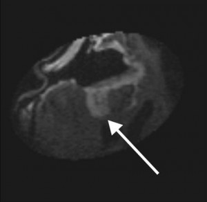 Figure 1. Intraoperative post-resection T1-weighted MR image in a patient with glioblastoma multiforme receiving ferumoxtran-10 for intraoperative imaging, demonstrating residual enhancing lesion posteriorly (arrow). This lesion was then localized by using integrated frameless stereotaxy and resected. Reproduced from Hunt et al, AJNR 2005.