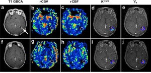 Figure 2. Axial dynamic MRI parametric maps of a pediatric patient with anaplastic oligoastrocytoma receiving ferumoxytol and gadolinium in a single imaging session. Circles indicate regions of interest. The top row images were obtained after a new small area of enhancement was noted in the resection cavity (A, arrow) on post-gadolinium T1-weighted MRI. Post-ferumoxytol DSC MRI parametric maps (B-C) demonstrate low vascularity: rCBVmax = 0.85 and rCBF = 0.57, while DCE MRI parametric maps (D-E) demonstrate elevated permeability: Ktrans max ≈ 0.23 and ve max ≈ 0.18. The bottom row images (F-J), obtained 3 months after the first DSC MRI, demonstrate minimally increased post-gadolinium enhancement (F) and post-ferumoxytol dynamic MRI parametric maps (G-J): rCBVmax = 0.99, rCBF = 0.90, Ktrans max ≈ 0.47, ve max ≈ 0.19. Findings on both studies and the lack of substantial temporal progression support pseudoprogression. Reproduced from J Neurooncol, 2012, with kind permission from Springer Science+Business Media B.V.4