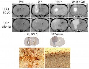 Figure 3. USPIO in brain tumor models. A, T1w MRI of LX1 small cell lung carcinoma brain metastases and U87 glioma. Precontrast images are shown and signal intensity changes 2 and 24 h after ferumoxtran-10, without or with GBCA. B, Histochemistry for iron oxide nanoparticles in rat brain tumors. Reprinted with permission from  Muldoon et al, Neurosurgery 2005.