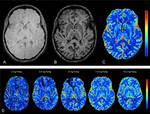 Figure 1. Pre (A) and post (B) ferumoxytol T2*-weighted (T2*w) images. The CBV maps are typically displayed with color coding (C). Axial SS-CBV maps with five different doses (D) visualize that higher ferumoxytol dose increases the image quality. Adapted with permission from Varallyay et al, Journal of Cerebral Blood Flow and Metabolism, 2013.1