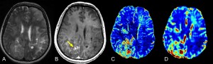 Figure 2. Comparison of SS-CBV and DSC-CBV maps. The coregistered anatomic T2-weighted (T2W) turbo spin echo (TSE) (A) and T1w MPRAGE post gadoteridol (B) scans describe the multifocal signal abnormalities. In corresponding slices, the SS-CBV (C) and DSC-CBV (D) maps show increased areas of CBV referring to highly vascular tumor areas. Note the mismatch between the most enhancing region (arrow) and the highest CBV values. Adapted with permission from Varallyay et al, Journal of Cerebral Blood Flow and Metabolism, 2013.1