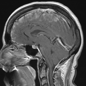 Sagittal T1-weighted postcontrast image shows the typical findings of intracranial hypotension, including low tonsils, flattened ventral pons, decreased mamillopontine distance, plump sella, and dilated intracranial and upper cervical spine veins.