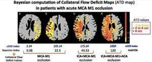 Bayesian MR PWI-derived ATD maps of four patients with an acute MCA-M1 occlusion