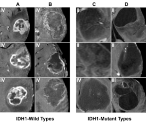 Machine Learning In Neuroimaging - AJNR News Digest