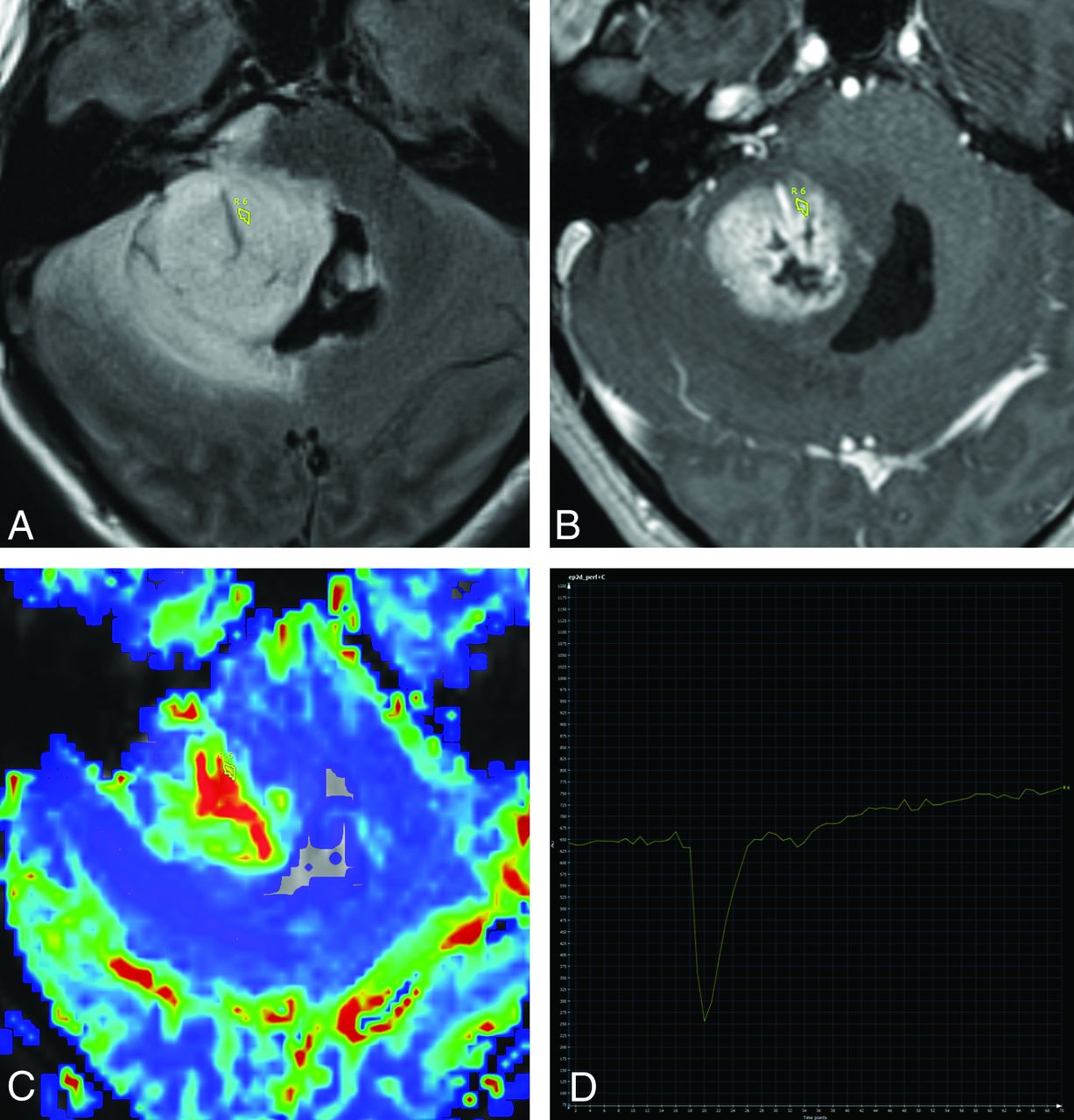 In Search Of Radiographic Quantitative Data For Pediatric Brain Tumors ...