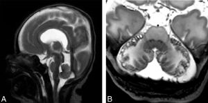 Characteristic MR Imaging Findings of the Neonatal Brain in RASopathies