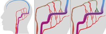 from Vollherbst DF, Ulfert C, Neuberger U, et al. Endovascular Treatment of Dural arteriovenous Fistulas Using Transarterial Liquid Embolization in Combination with Transvenous Balloon-Assisted Protection of the Venous Sinus. AJNR Am J Neuroradiol. 2018 July.