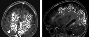 Save The Brain Or Save The Kidneys? Contrast Safety In Neuroimaging ...